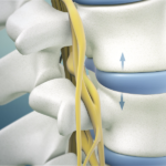 Understanding Degenerative Disc Disease Causes, Symptoms, and Treatment Spinerap